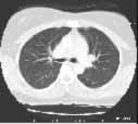 chest-ct-lungs