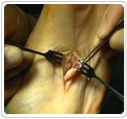 cyst