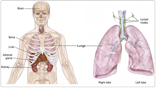 lung1