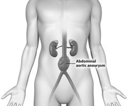 Abdominal Thoracic Aortic Aneurysm Surgery India
