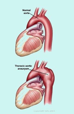Abdominal Thoracic Aortic Aneurysm Surgery India